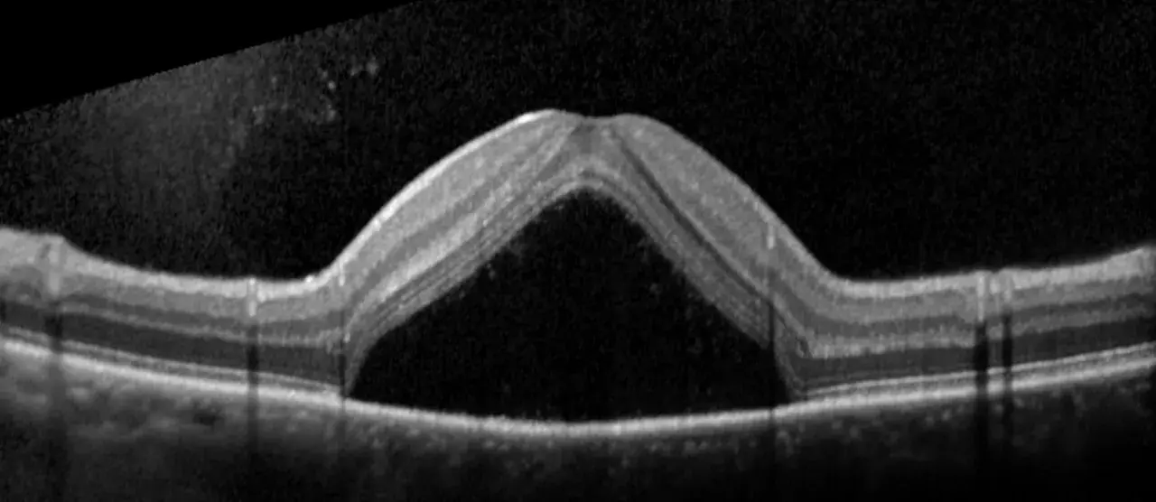 OCT di occhio con corioretinopatia sierosa centrale. Evitare stress e cortisone per non peggiorare la condizione.