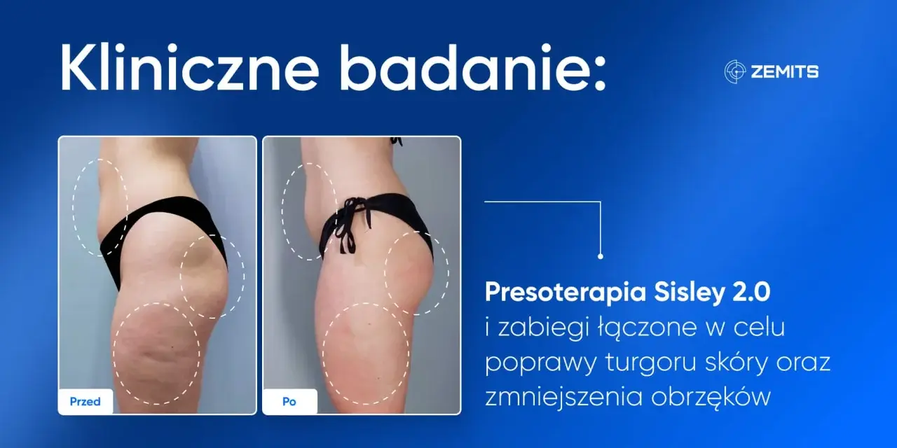 Przed i po zabiegu Presoterapia Sisley 2.0. Widoczna poprawa sylwetki dzięki mechanicznemu drenażowi limfatycznemu, redukcja obrzęków i cellulitu.