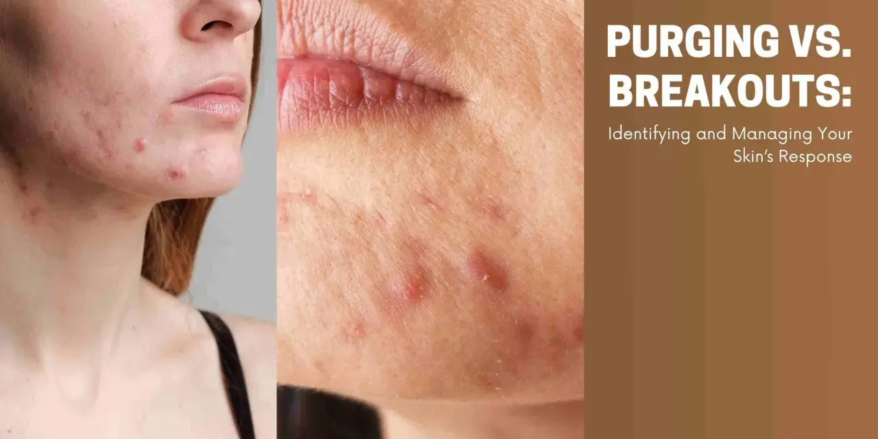 Close-up of a face with acne, showing breakouts after starting a new skincare routine. Text reads "PURGING VS. BREAKOUTS: Identifying and Managing Your Skin's Response.