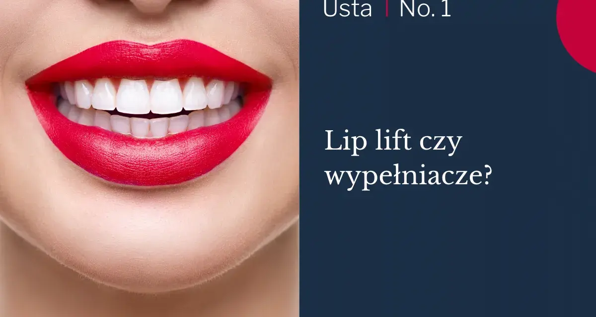 Usta po zabiegu lip lift, z idealnie białymi zębami i czerwonymi ustami.