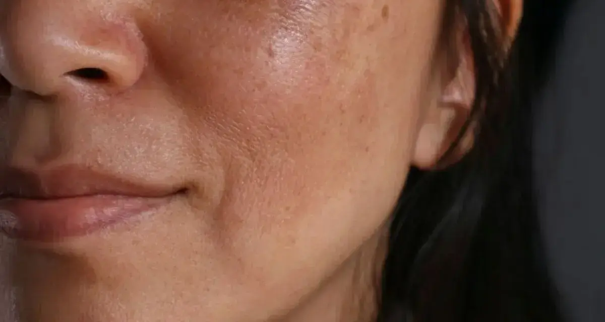 Primo piano del viso di una donna con evidenti macchie solari e discromie sulla pelle.