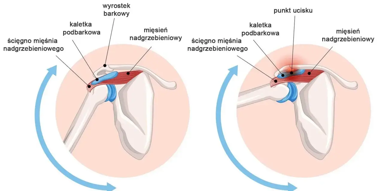 Staw barkowo obojczykowy: prawidłowe położenie ścięgna mięśnia nadgrzebieniowego i kaletki podbarkowej po lewej, ucisk i stan zapalny po prawej.