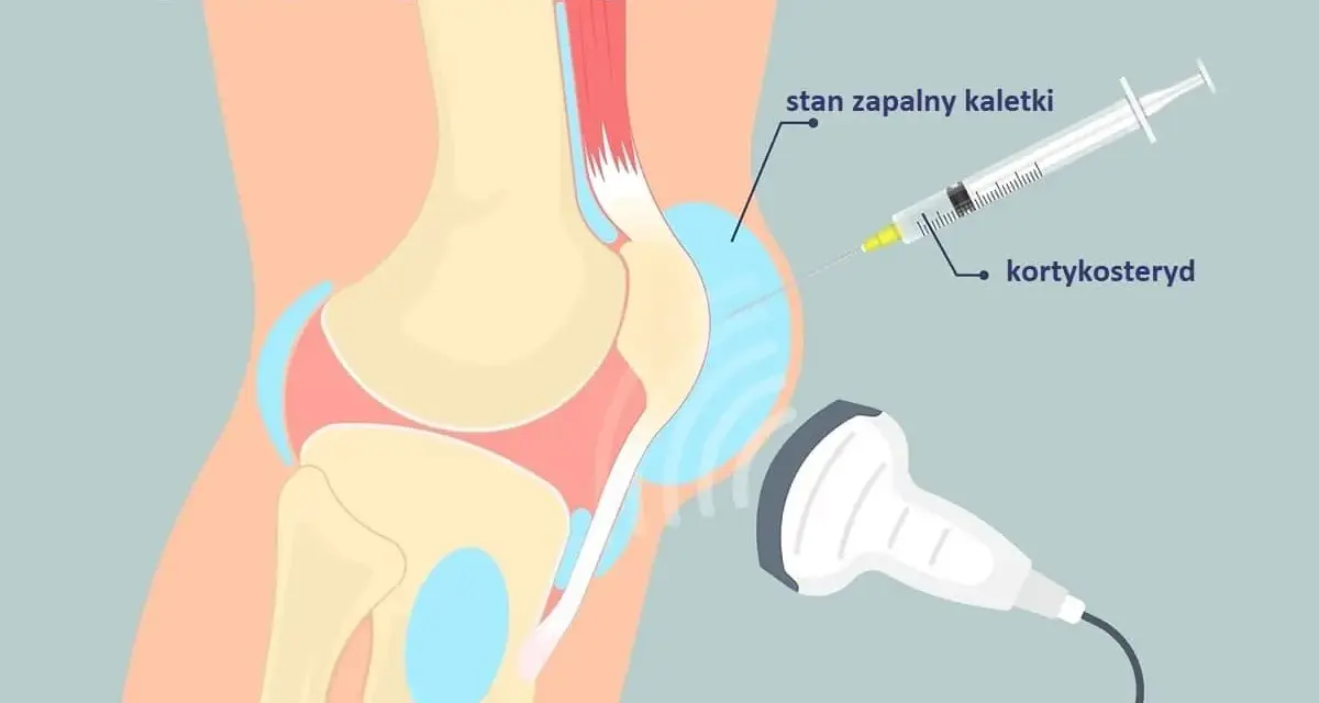 Ilustracja przedstawia blokadę stawową kolana. Zastrzyki w kolano z kortykosteroidem pod kontrolą USG pomagają przy stanie zapalnym kaletki.