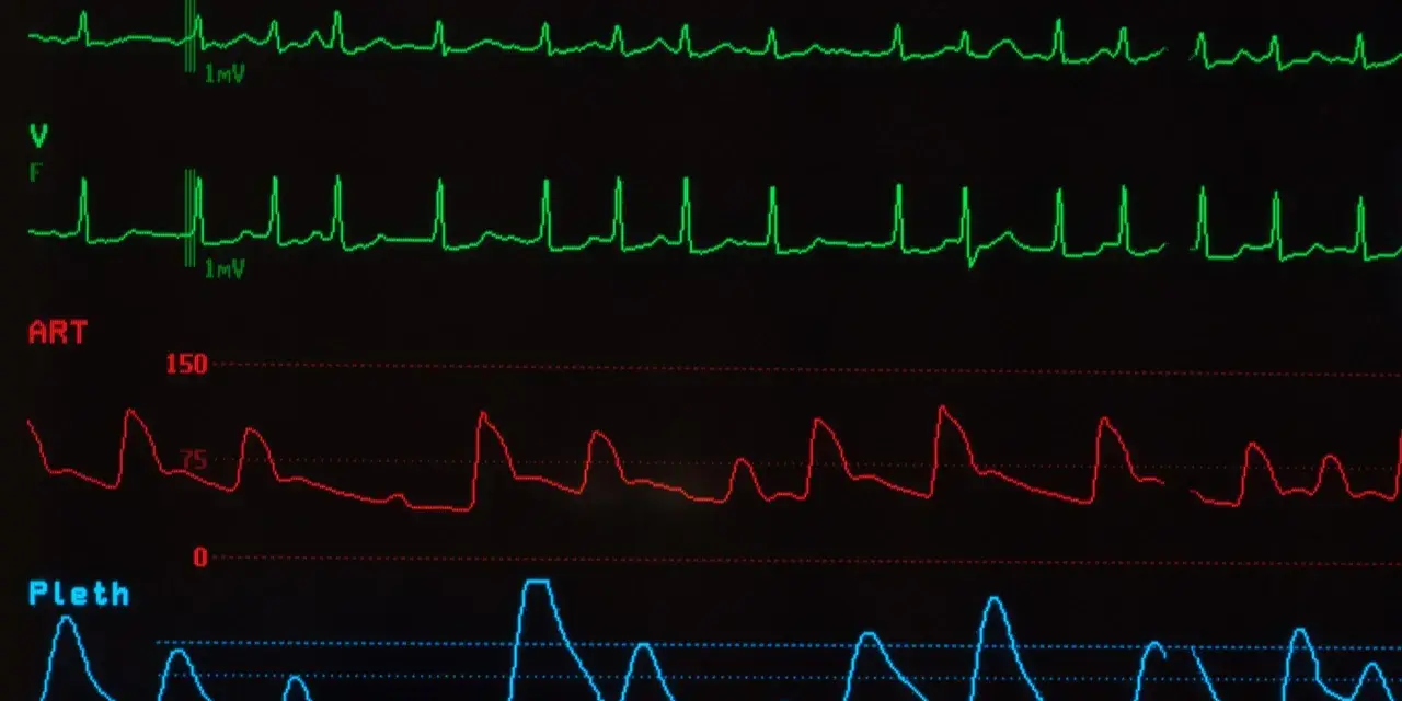 Monitor EKG pokazuje nieregularne fale, sugerujące migotanie przedsionków. Widoczne są również linie ciśnienia krwi i pulsoksymetrii.