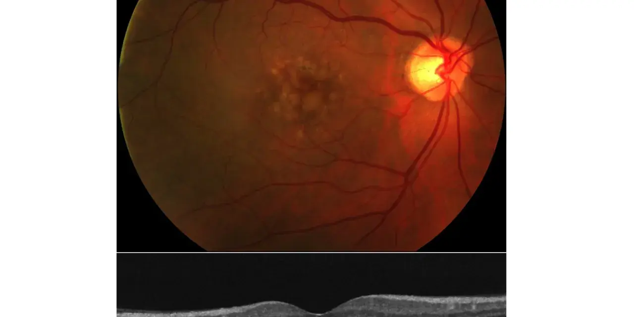 Immagine OCT e fondo oculare che mostrano segni di degenerazione maculare, il cui significato è cruciale per la diagnosi.