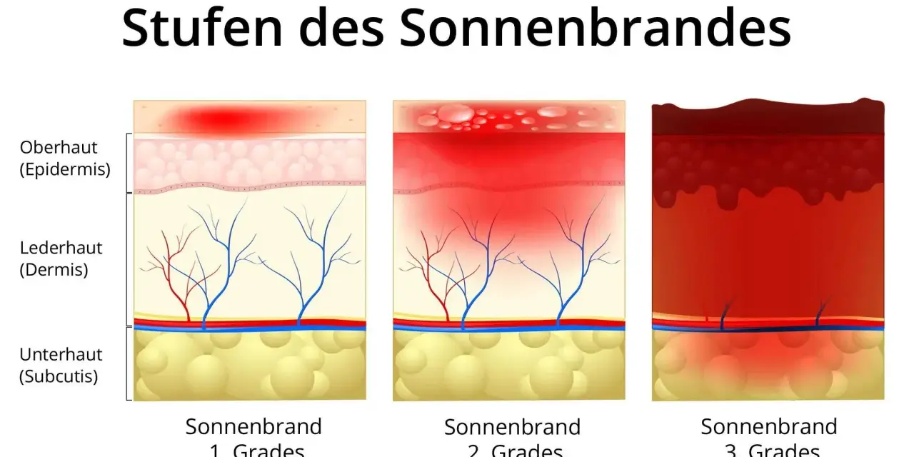 Illustrationen zeigen Hautschichten bei Sonnenbrand 1., 2. und 3. Grades. Der Sonnenbrand 2. Grades zeigt Blasenbildung in der Epidermis und Rötung der Dermis.