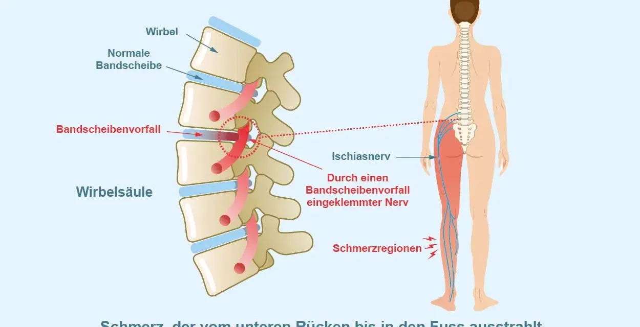 Illustration zeigt Bandscheibenvorfall, der Ischiasnerv reizt. Schmerz strahlt vom Rücken ins Bein aus. Mögliche Linderung durch Ischias Medikamente.