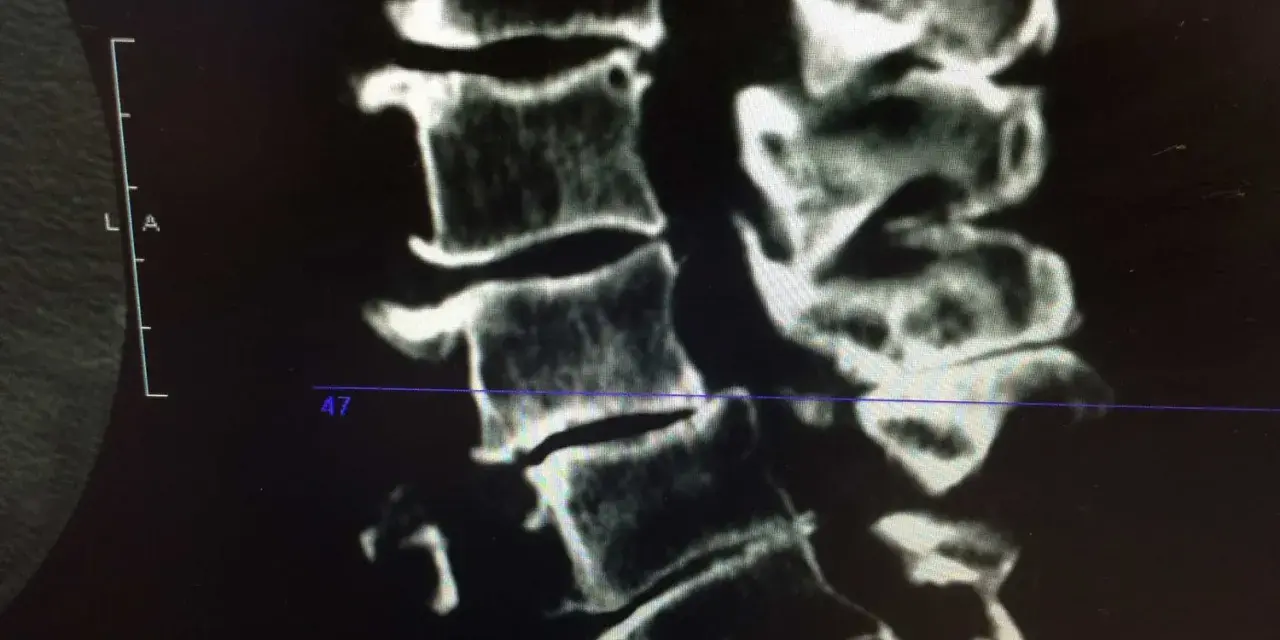 Radiographie montrant l'arthrose cervicale d'un cheval, avec des signes de dégénérescence osseuse au niveau des vertèbres.
