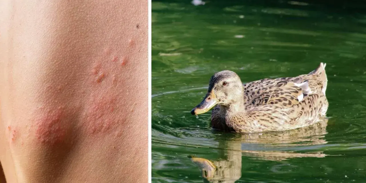 Haut mit roten Pusteln, die auf einen Zerkarien Ausschlag hindeuten, neben einer Ente im Wasser.