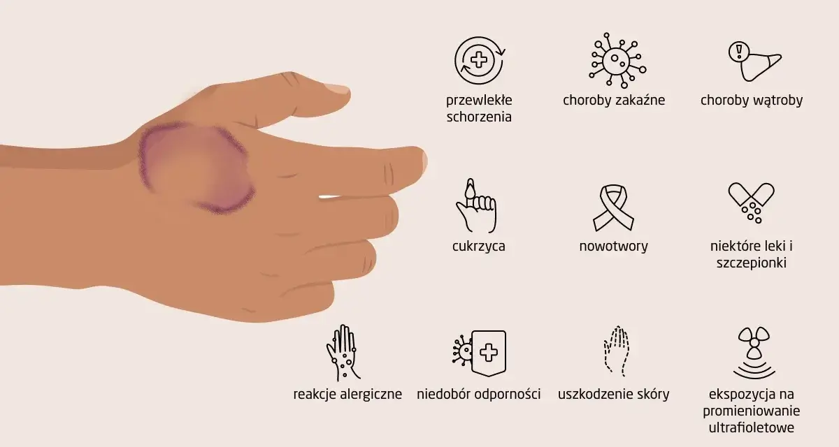 Dłoń z widocznym ziarniniakiem obrączkowatym. Obok ikony symbolizujące możliwe przyczyny: choroby, cukrzyca, nowotwory, leki, alergie, uszkodzenia skóry, promieniowanie UV.