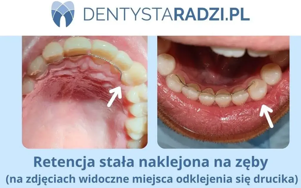 Ile kosztuje nakładka retencyjna? Ceny, opcje i porady eksperta
