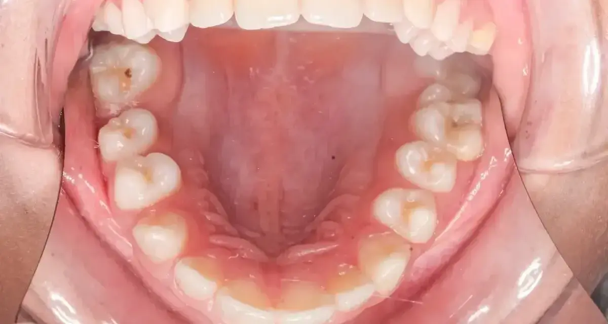 Widok jamy ustnej z zębami i różowym podniebieniem. Dziąsła wyglądają na lekko zaczerwienione, jakby były poparzone.