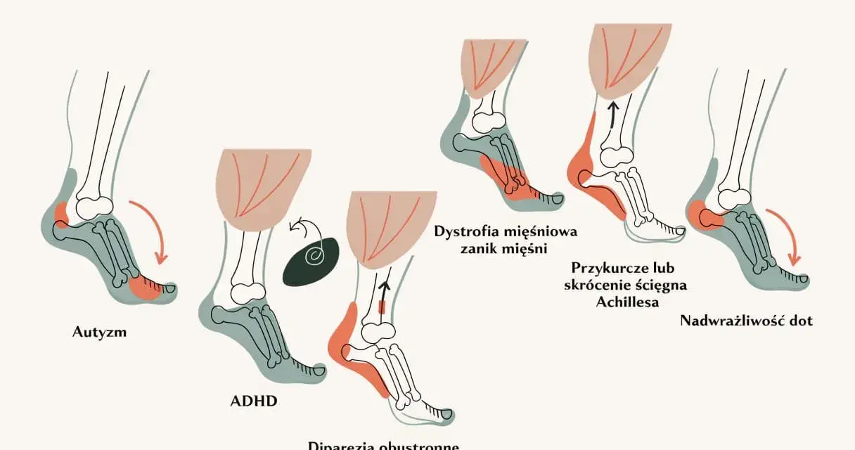 Ilustracja pokazuje, dlaczego dziecko chodzi na palcach: autyzm, ADHD, dystrofia mięśniowa, przykurcz ścięgna Achillesa, nadwrażliwość dotykowa i dipareza kurczowa.