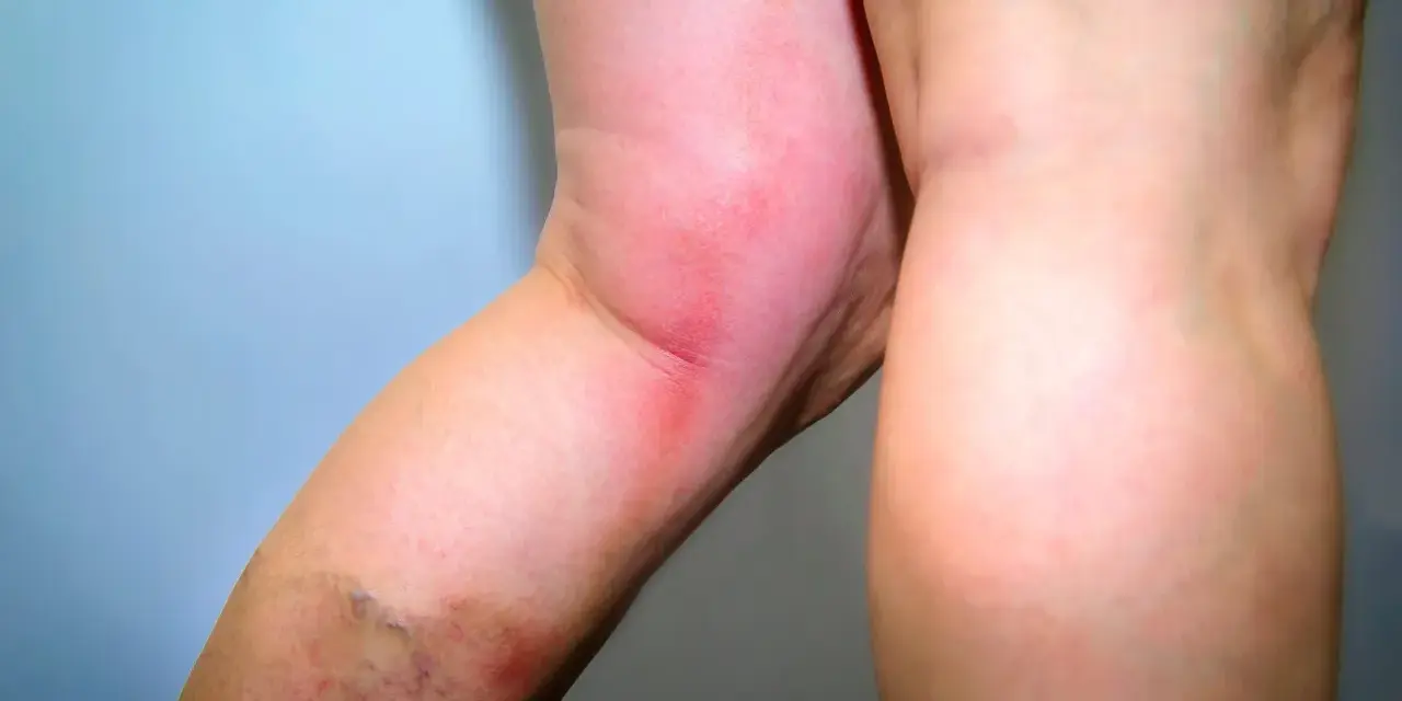 Rotes, geschwollenes Bein mit sichtbaren Krampfadern. Möglicherweise keine thrombosespritze nach op.