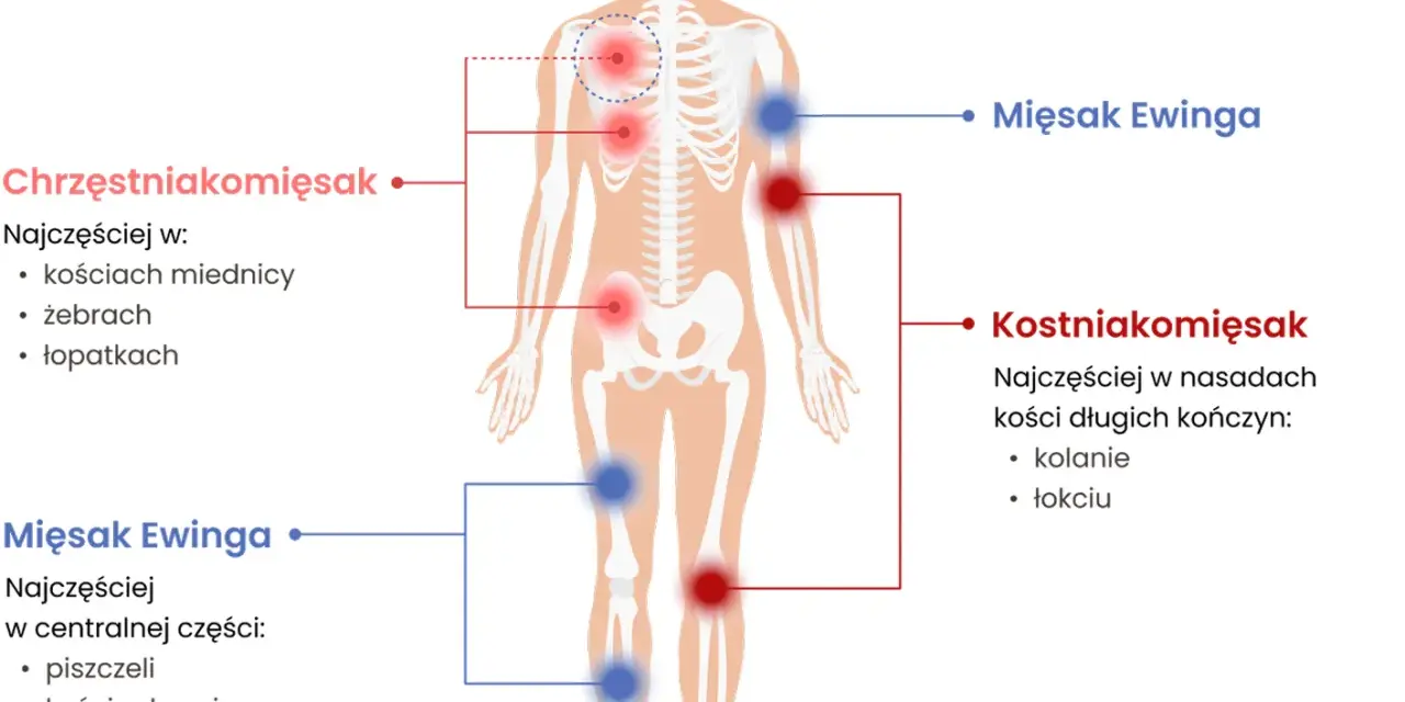 Schemat przedstawia lokalizację mięsaków: chrzęstniakomięsaka w miednicy, żebrach i łopatkach, a mięsaka Ewinga w piszczeli, kości udowej i ramiennej.