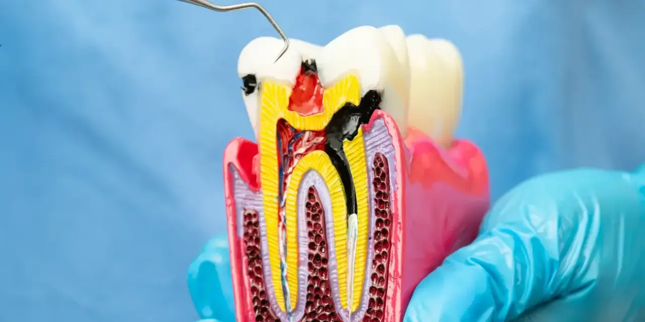 Model zęba z widocznym ubytkiem i narzędziem dentystycznym. Zastanawiasz się nad leczeniem kanałowym? Cena może być niższa niż myślisz.