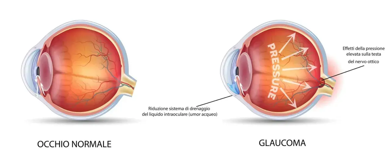 Confronto tra occhio normale e occhio con glaucoma. L'immagine mostra come la pressione elevata nel glaucoma danneggi il nervo ottico.