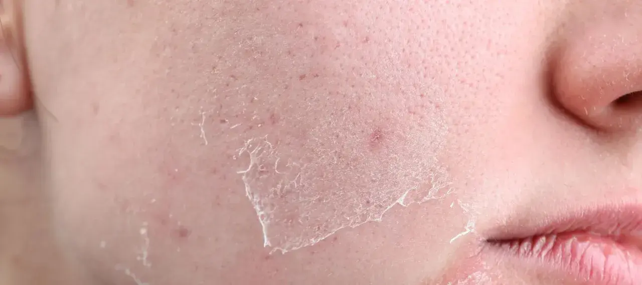 Close-up of dry, flaky skin with peeling patches, indicating what causes transepidermal water loss.