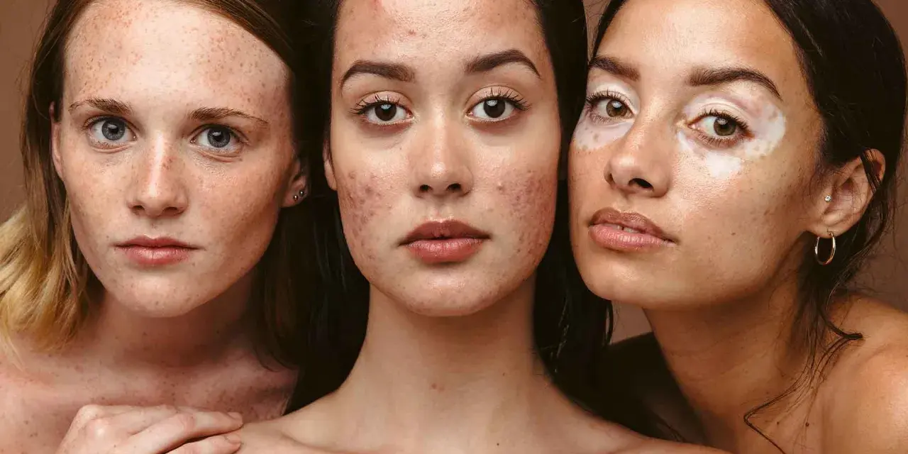 Drei Frauen mit unterschiedlichen Hauttypen: Sommersprossen, Akne und Vitiligo. Jede Haut verdient die passende mischhaut pflege.