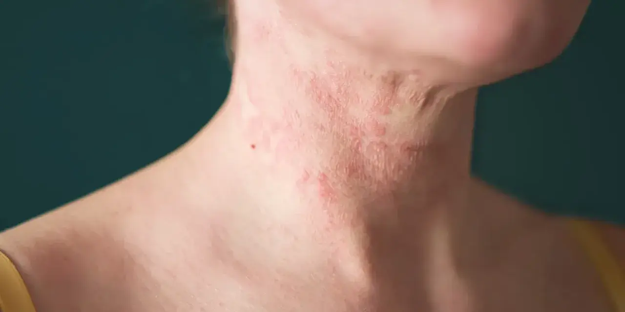 Close-up of a person's neck with red, inflamed eczema. Some find relief from itching, wondering why does hot water feel good on eczema.