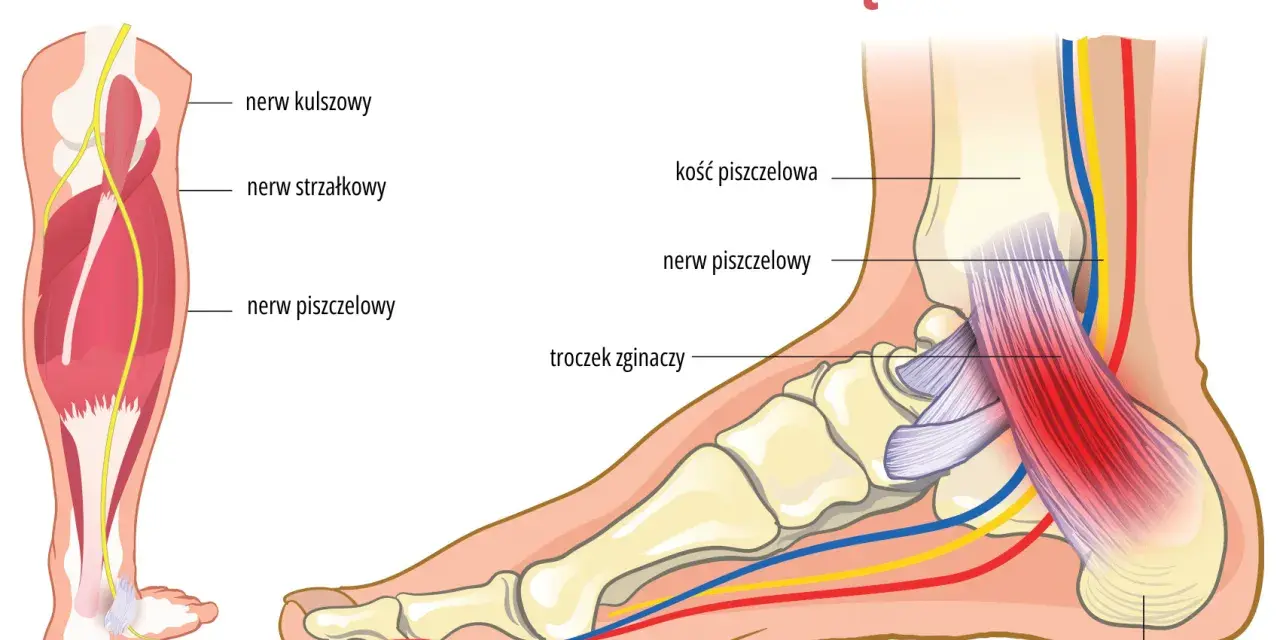 Ilustracja pokazuje anatomię stopy i łydki, z zaznaczonym nerwem piszczelowym. Może pomóc zrozumieć neuropatię i jej objawy.