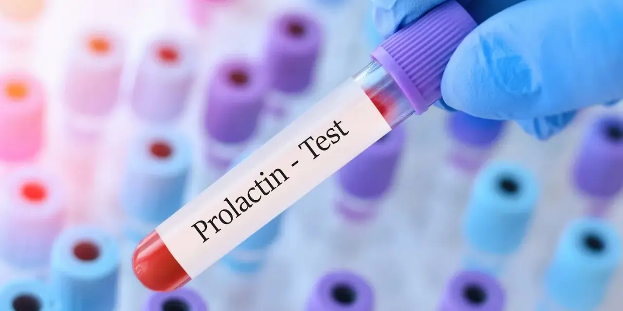 Ręka w niebieskiej rękawiczce trzyma probówkę z napisem "Prolactin - Test". Kiedy badać prolaktynę? To pytanie często zadawane przez pacjentów.