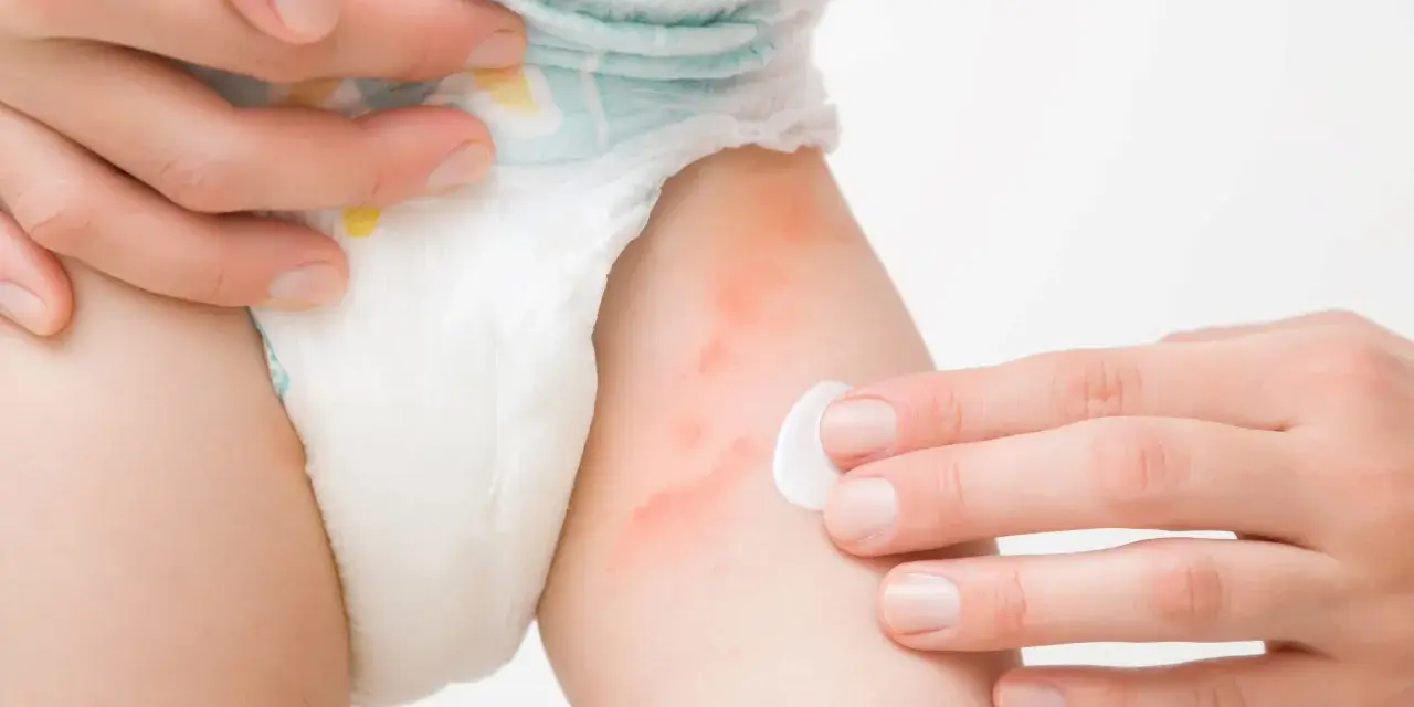 Czerwone, podrażnione miejsca na skórze dziecka, widoczne pod pieluszką, pokazują, jak wygląda uczulenie na pampersy. Dłoń aplikuje krem.