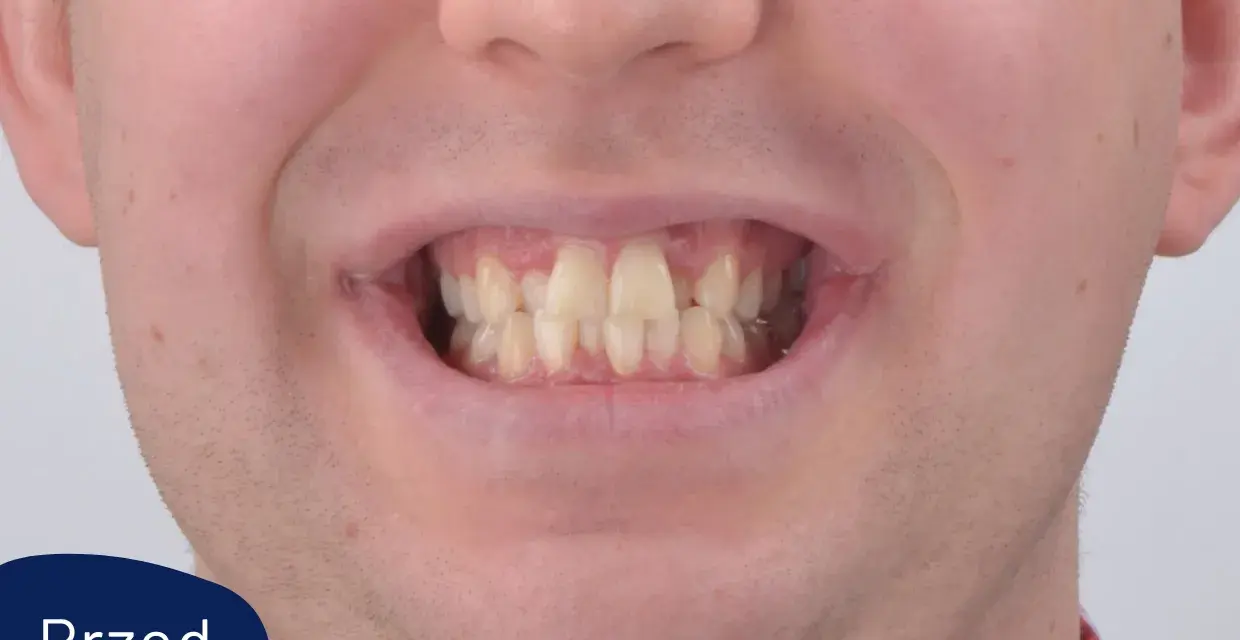 Uśmiech przed leczeniem aparatem Invisalign. Widoczne nierówne i lekko pożółkłe zęby.