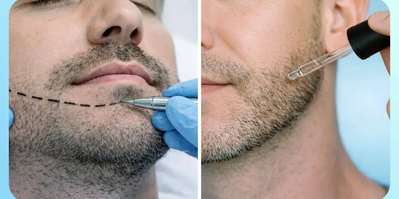 Doble imagen: un hombre con línea marcada en la barba y un aplicador, y otro hombre recibiendo gotas de minoxidil.