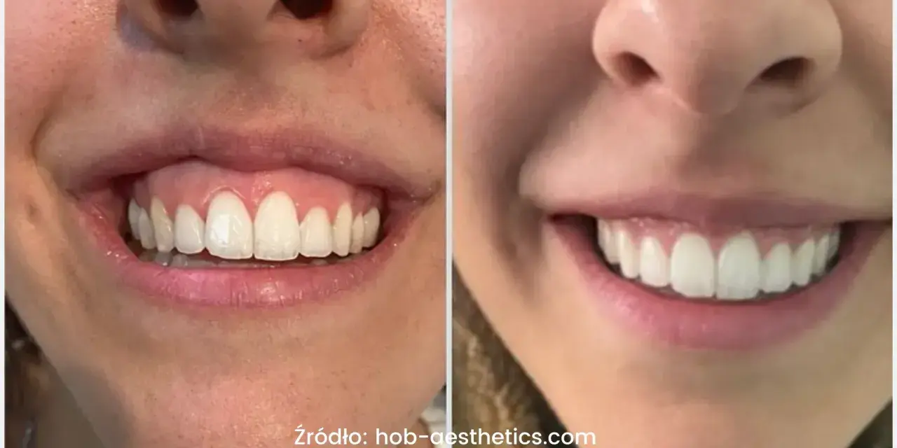 Uśmiech z widocznymi zębami i dziąsłami, porównanie przed i po zabiegu. Zniknął problem gummy smile.