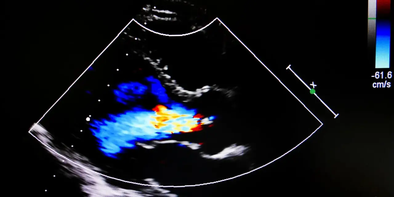 Obraz USG serca z kolorowym Dopplerem, pokazujący przepływ krwi. Może być pomocny w diagnostyce przewlekłej niewydolności żylnej.