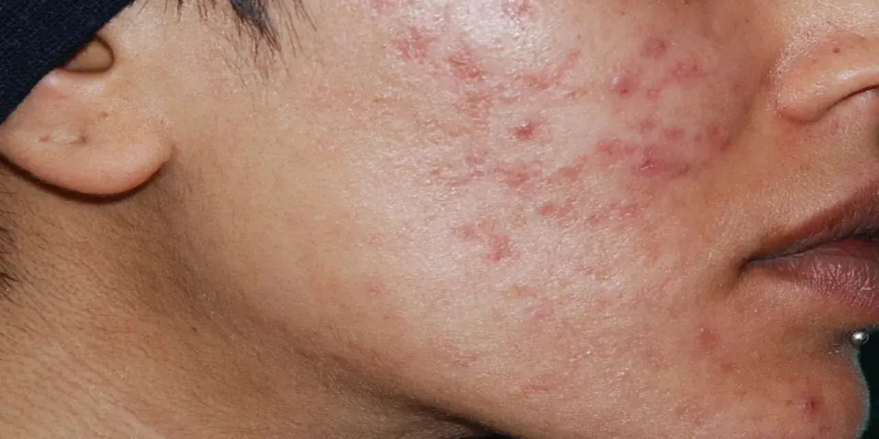 Primo piano del viso di una persona con evidenti cicatrici da acne sul lato destro della guancia e sul mento.