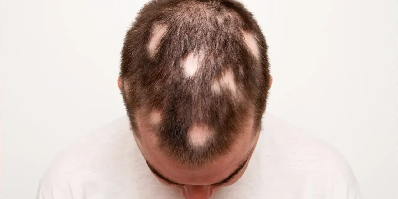 Calvizie a chiazze sulla testa di un uomo, sintomo di alopecia da stress.