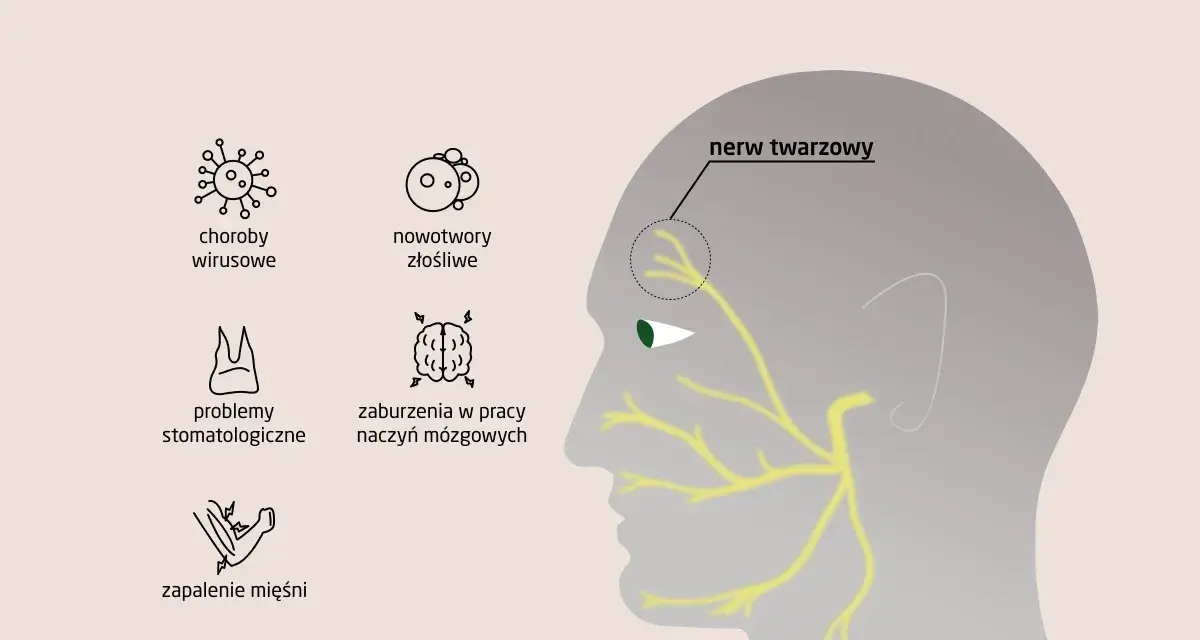 Ilustracja przedstawia przyczyny zapalenia nerwu twarzowego, w tym neuralgia nerwu trójdzielnego, choroby wirusowe, nowotwory, problemy stomatologiczne, zaburzenia naczyń mózgowych i zapalenie mięśni.