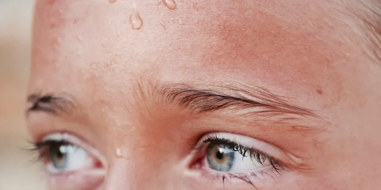 Gotas de sudor en la frente de una persona, un síntoma común de hiperhidrosis facial.