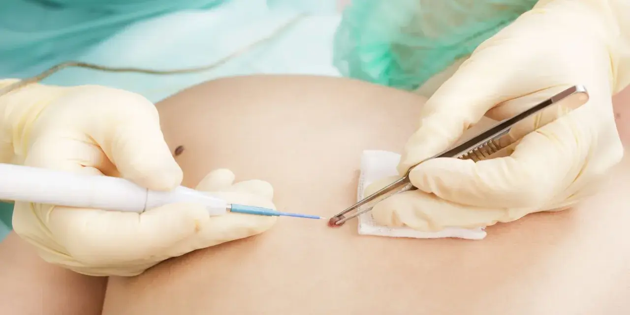 Arzt entfernt mit Pinzette und Laser ein Muttermal rot umrandet.