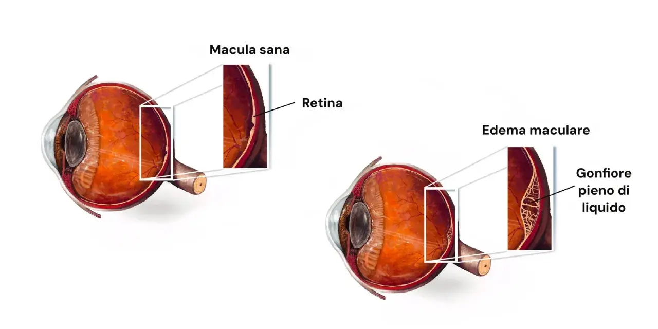 Confronto tra occhio sano e occhio con edema maculare. L'edema maculare si riassorbe, mostrando la retina gonfia e piena di liquido.