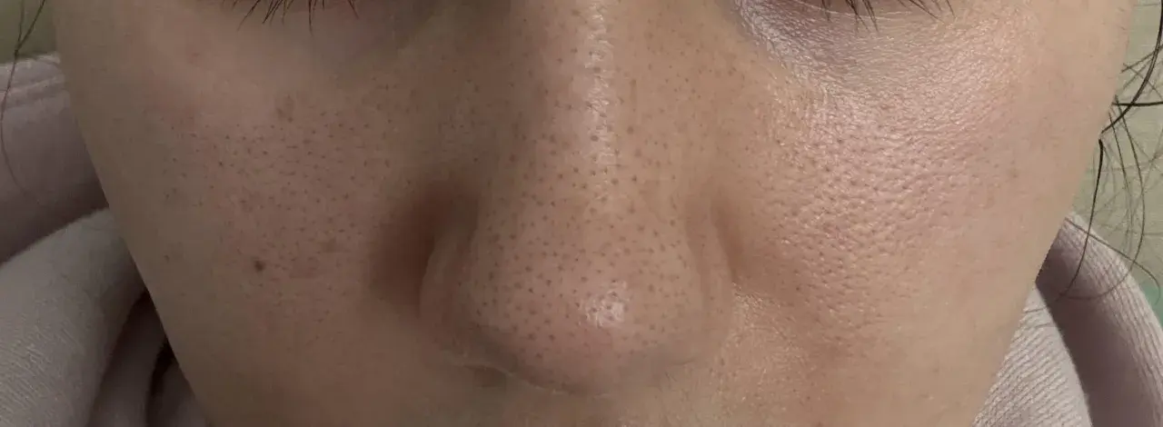 Primo piano del naso con evidenti punti neri, la pelle appare lucida e porosa.