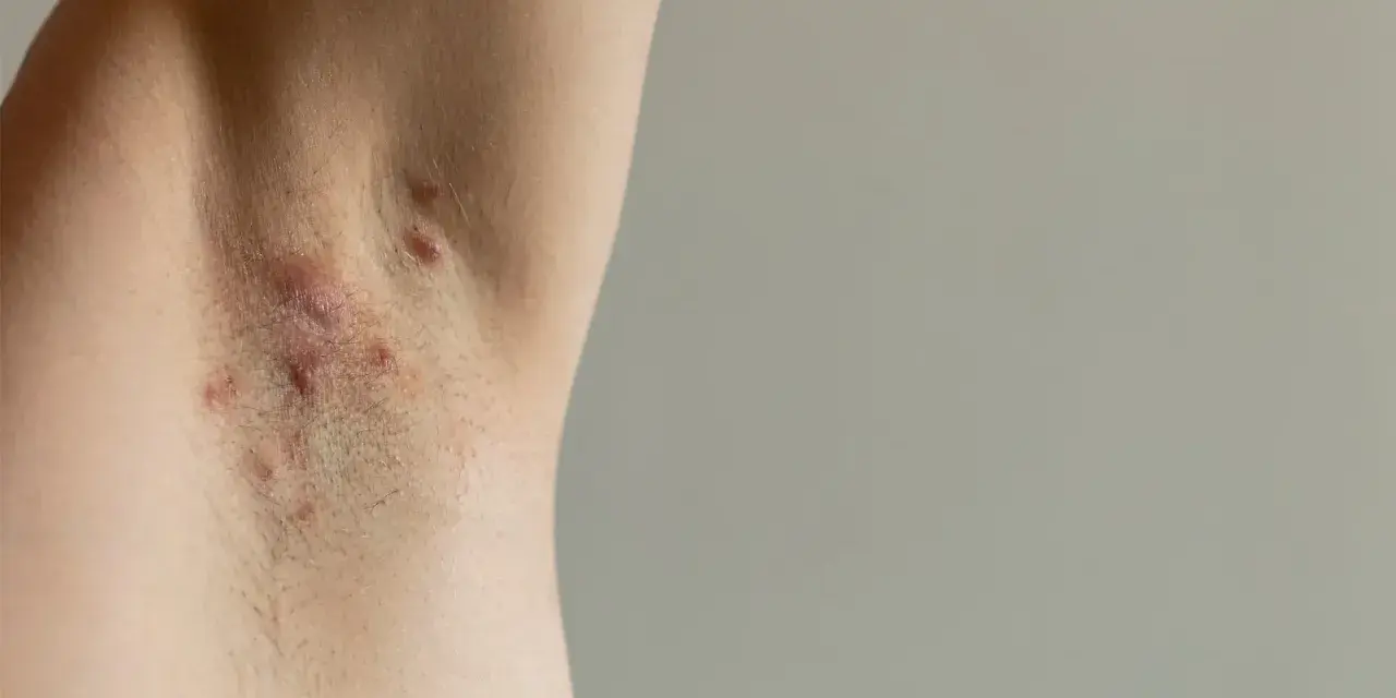 Skóra pod pachą z widocznymi zmianami zapalnymi, które mogą wskazywać na trądzik odwrócony.