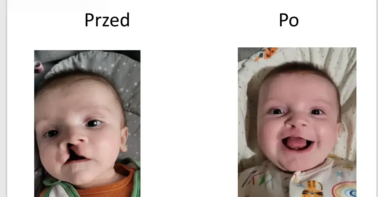 Uśmiechnięte dziecko po korekcie rozszczepu wargi. Wcześniej widoczna była zajęcza warga.