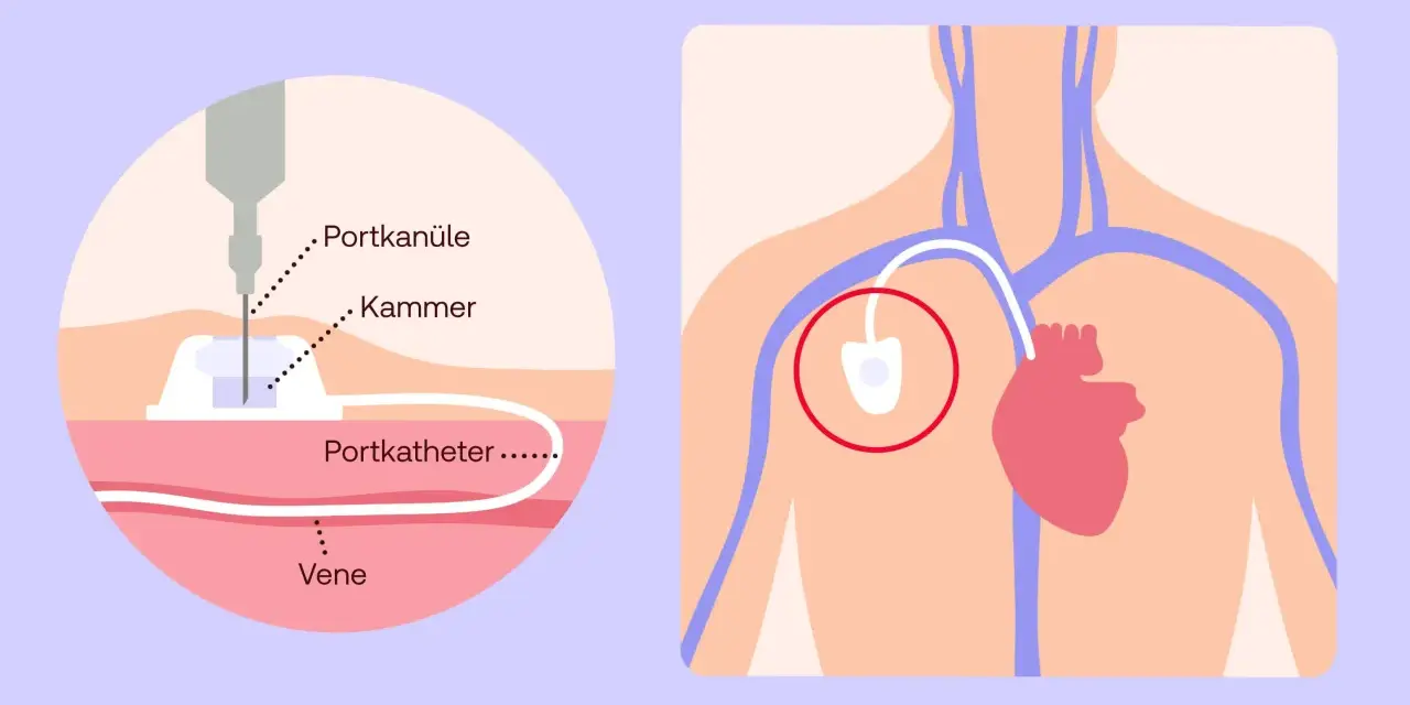 Illustration zeigt eine Portkanüle, die in eine Vene eingeführt wird, um Chemotherapie zu verabreichen.
