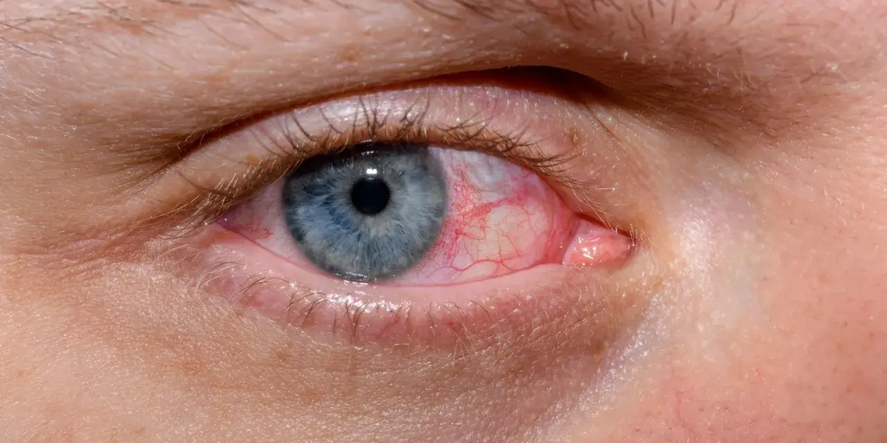 Occhio azzurro con congiuntiva arrossata e vasi sanguigni evidenti. Esistono gli occhi rossi, un segno di irritazione o infezione.
