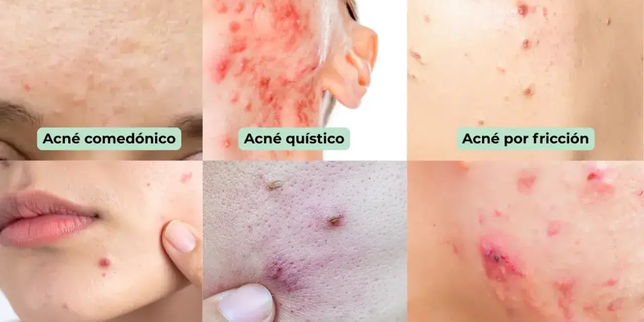 Seis tipos de acné: comedónico, quístico, por fricción, hormonal, inflamatorio y   conglobata.