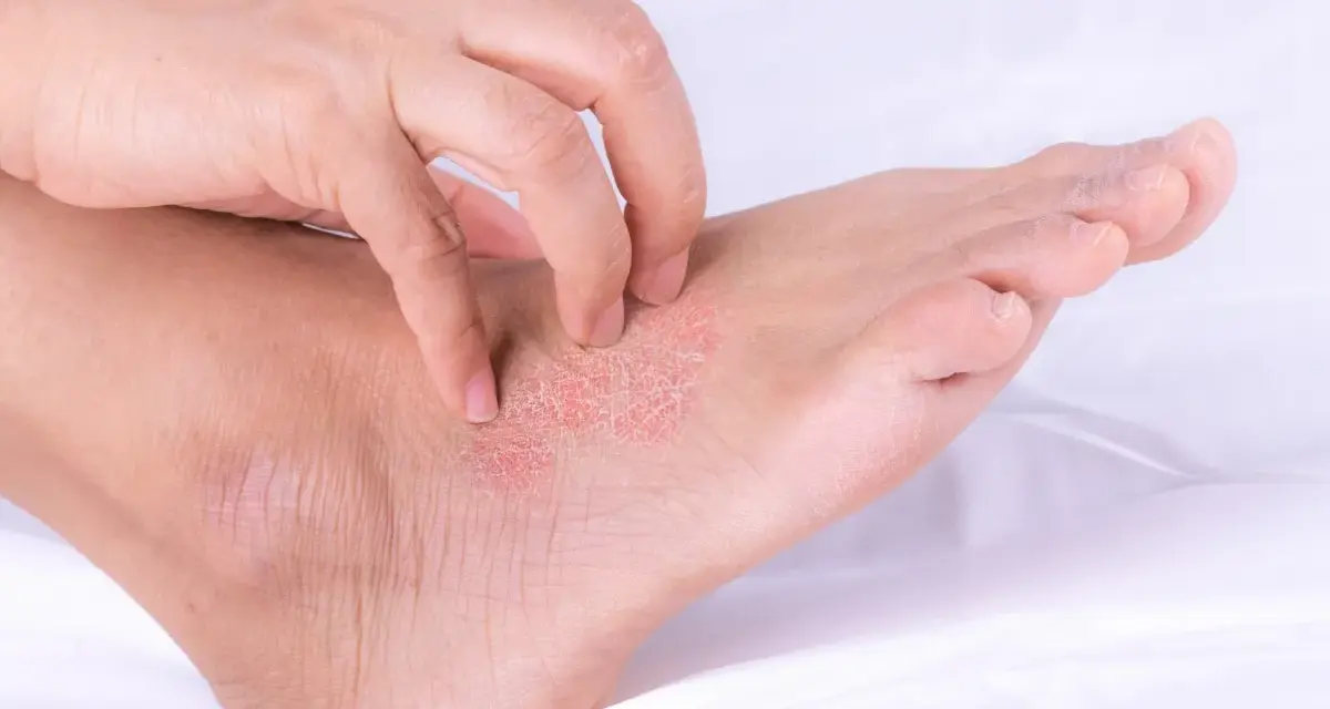 Una mano se rasca la piel escamosa y enrojecida de un pie, mostrando los efectos de la psoriasis en los pies.
