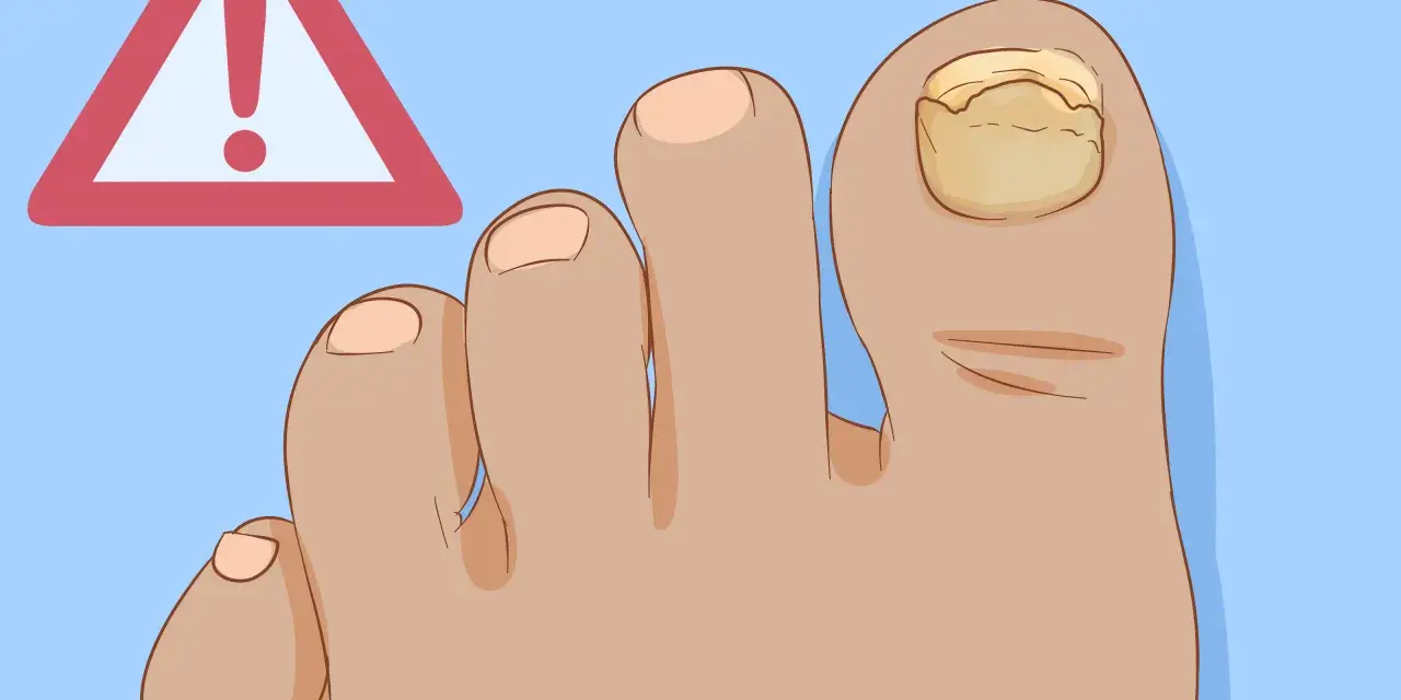 Alluce senza unghia cosa fare? Attenzione! L'unghia dell'alluce è ingiallita e ispessita, segno di possibile micosi.