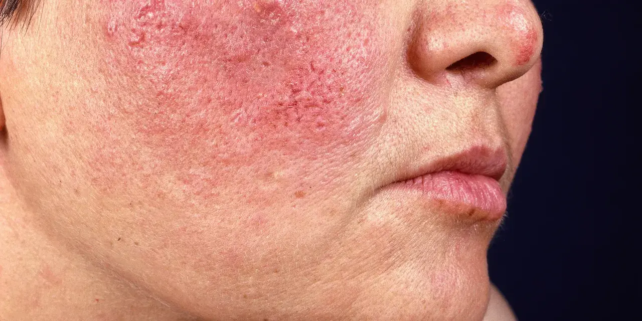 Rote Gesichtshaut? Finden Sie die perfekte Creme & Ursachen