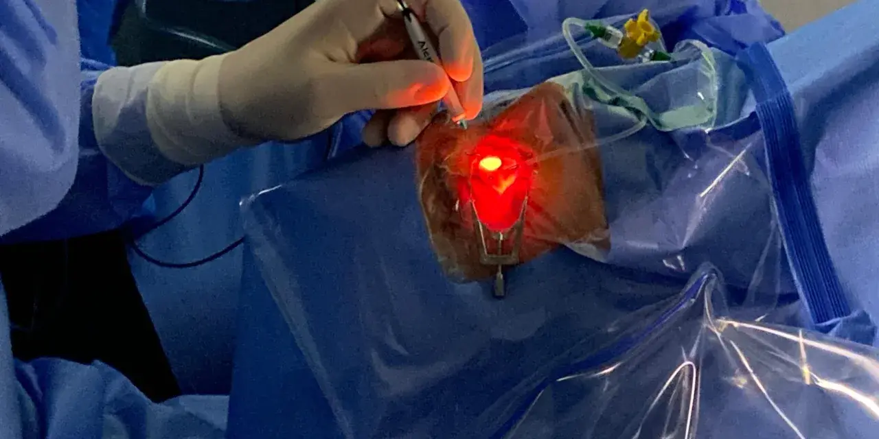 Un chirurgo esegue una vitrectomia, un intervento per rimuovere il corpo vitreo dall'occhio.