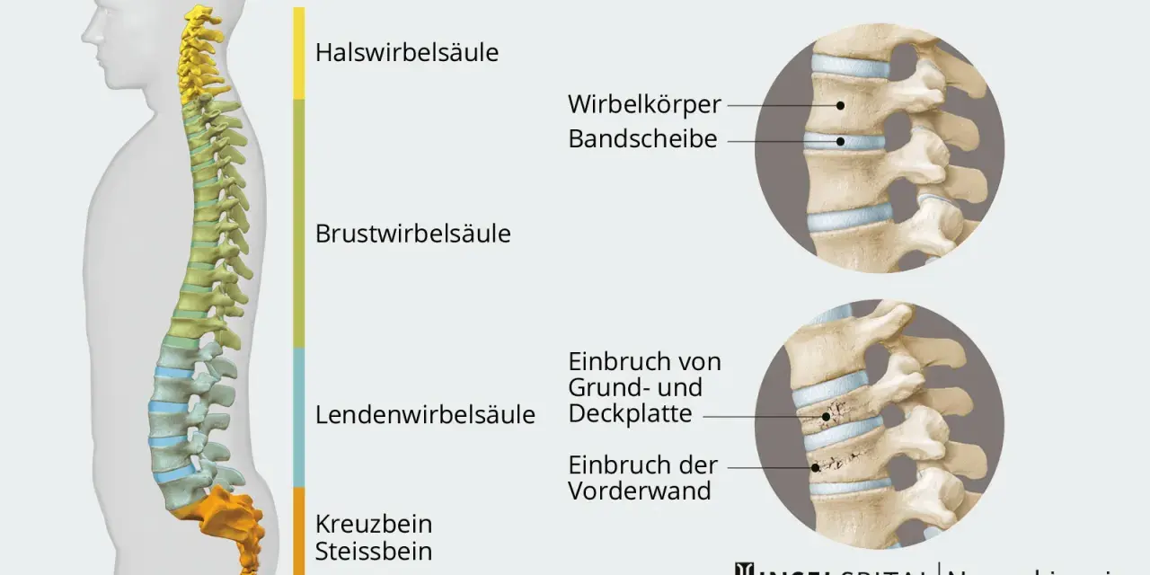 Illustration der Wirbelsäule mit Darstellung eines Wirbelbruchs. Mögliche wirbelbruch symptome werden durch die gezeigten Frakturen verdeutlicht.