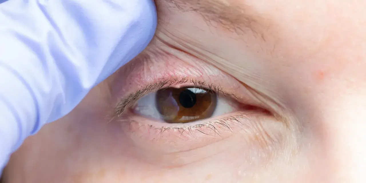 Occhio con palpebra sollevata da guanto blu, evidenziando arrossamento e possibili ghiandole di meibomio ostruite, cause di disagio.