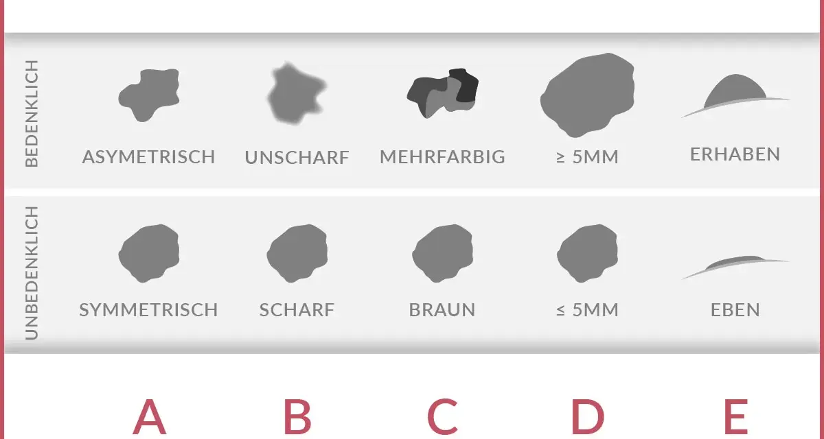 ABCDE-Regel zur Früherkennung von Hautkrebs: Asymmetrie, Begrenzung, Colorit, Durchmesser, Erhabenheit. Hilft, Hautkrebs frühzeitig zu erkennen.